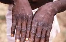 Guiné-Bissau confirma primeiro caso de MPOX